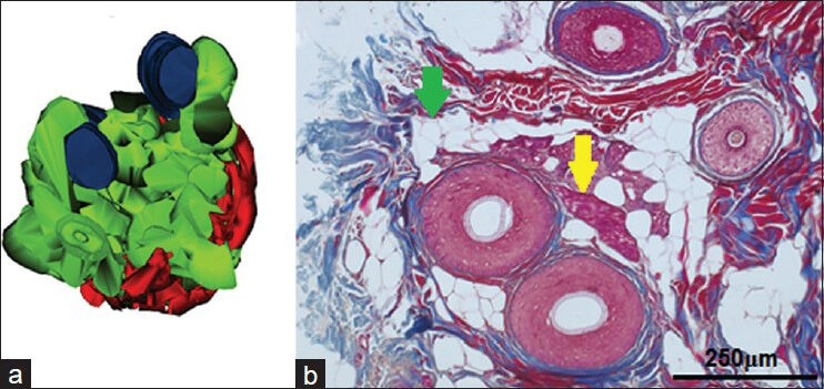 Fat degeneration of arrector pili muscle and estrogen receptors